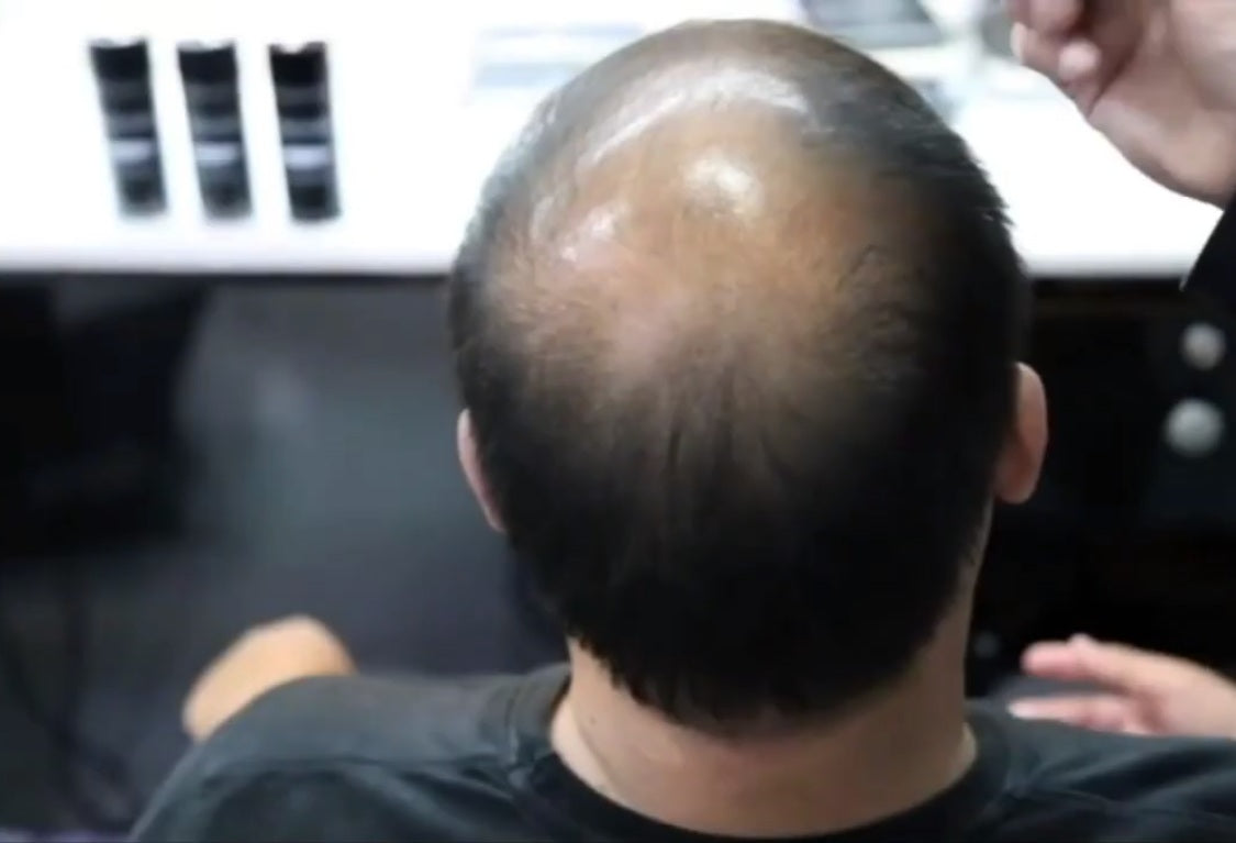 Hair Finbers For Hair Loss In Men and women